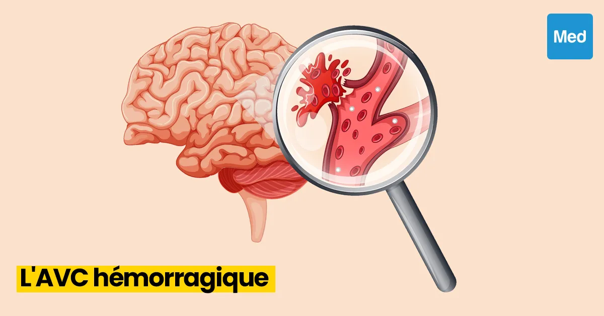 Comprendre l'AVC Hémorragique : Causes, Symptômes et Prise en Charge